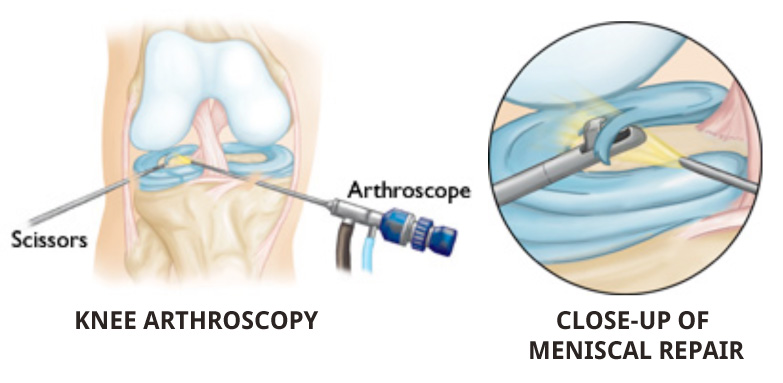 How is arthroscopic knee surgery performed?