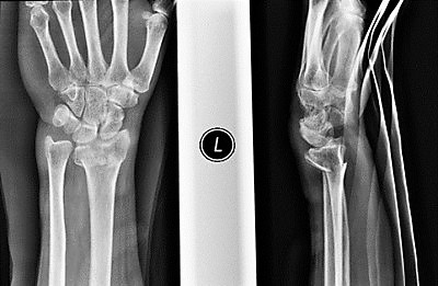 腕关节骨折的术前X光检查 -手腕骨折手术