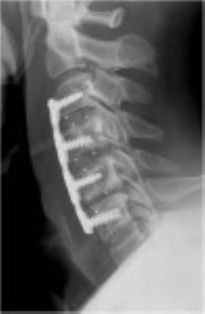 Neck Pain Treatment - Anterior cervical discectomy and fusion