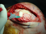 microfracture cartilage repair