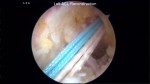 Left ACL Reconstruction