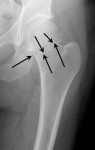Stable Impacted Hip Fracture