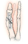 arthrodesis foot surgery
