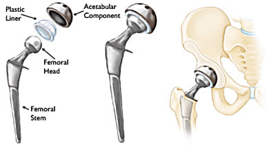 Total Hip Replacement tools
