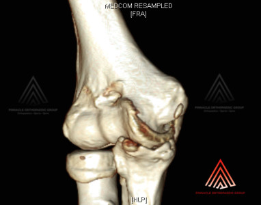 Elbow Spur CT Scan