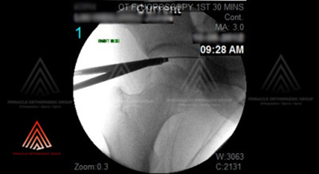 Distraction of femoral head and introduction of arthrosocpic equipments into hip joint