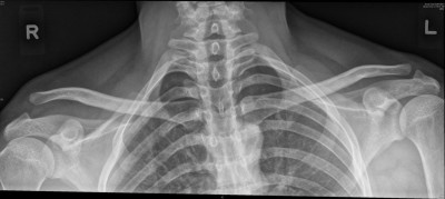 X-ray showing right ACJ dislocation