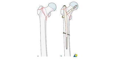 Osteoporotic fracture - intertrochanteric fracture and fixation