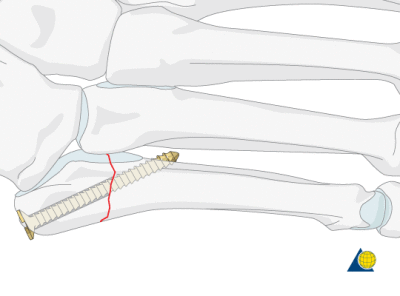 long screw in the bone canal