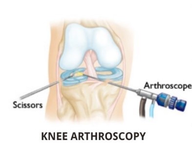 Knee Arthroscopy - Image from AAOS.org