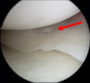 Traumatic meniscus tear in a young patient seen during arthroscopy