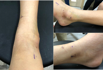 Ankle instability treatment 