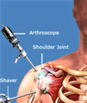 Arthroscopic rotator cuff repair 