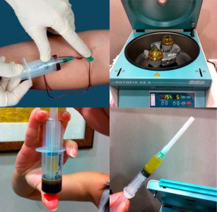 Peripheral blood being prepared, centrifuged and concentrated to form PRP