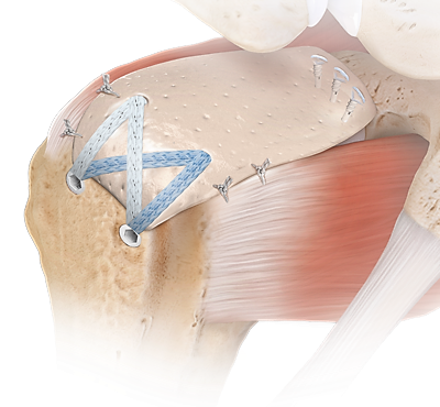 Allograft tissue being used during arthroscopic superior capsule reconstruction to fill the void left by an irreparable cuff tear