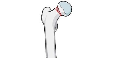 股骨颈骨折（图像-感谢AOTrauma惠赠）- 骨质疏松性骨折