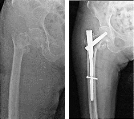 左X射线图像-股骨转子间骨折，右X射线图像-固定骨折。