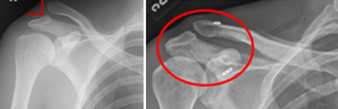 X-rays of a patient with right ACJ dislocation before and after surgical reduction 