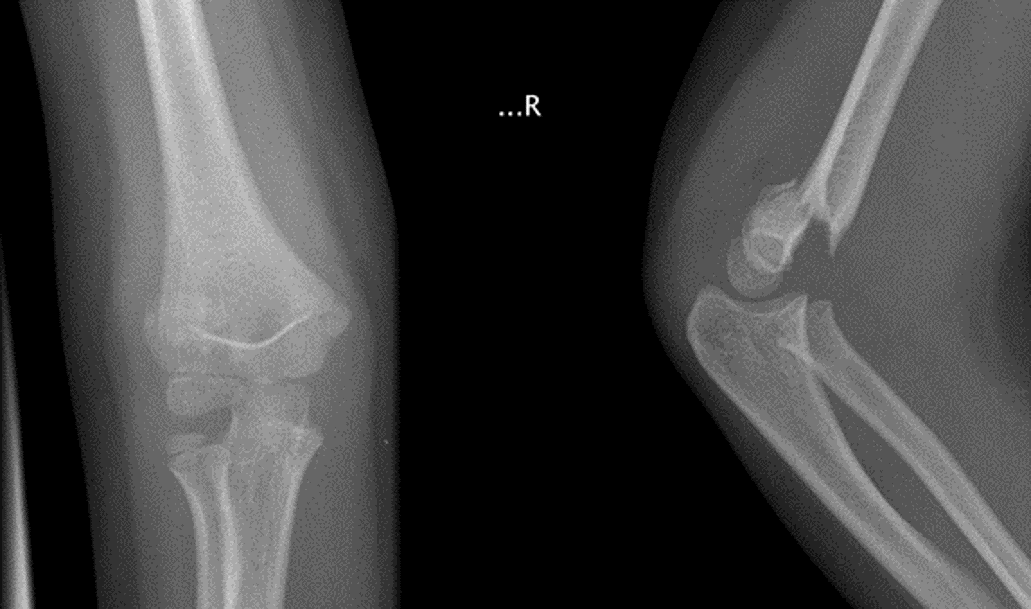 图15：型损伤的骨折发生移位，需要手术固定。
