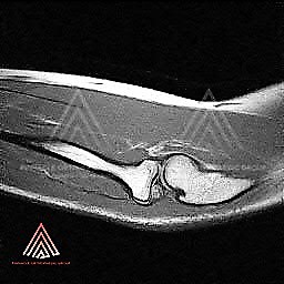 外侧尺骨副韧带(LUCL)损伤导致后-外侧旋转不稳(PLRI)的磁共振成像