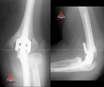 肘关节置换 术治疗肘关节炎的X光片