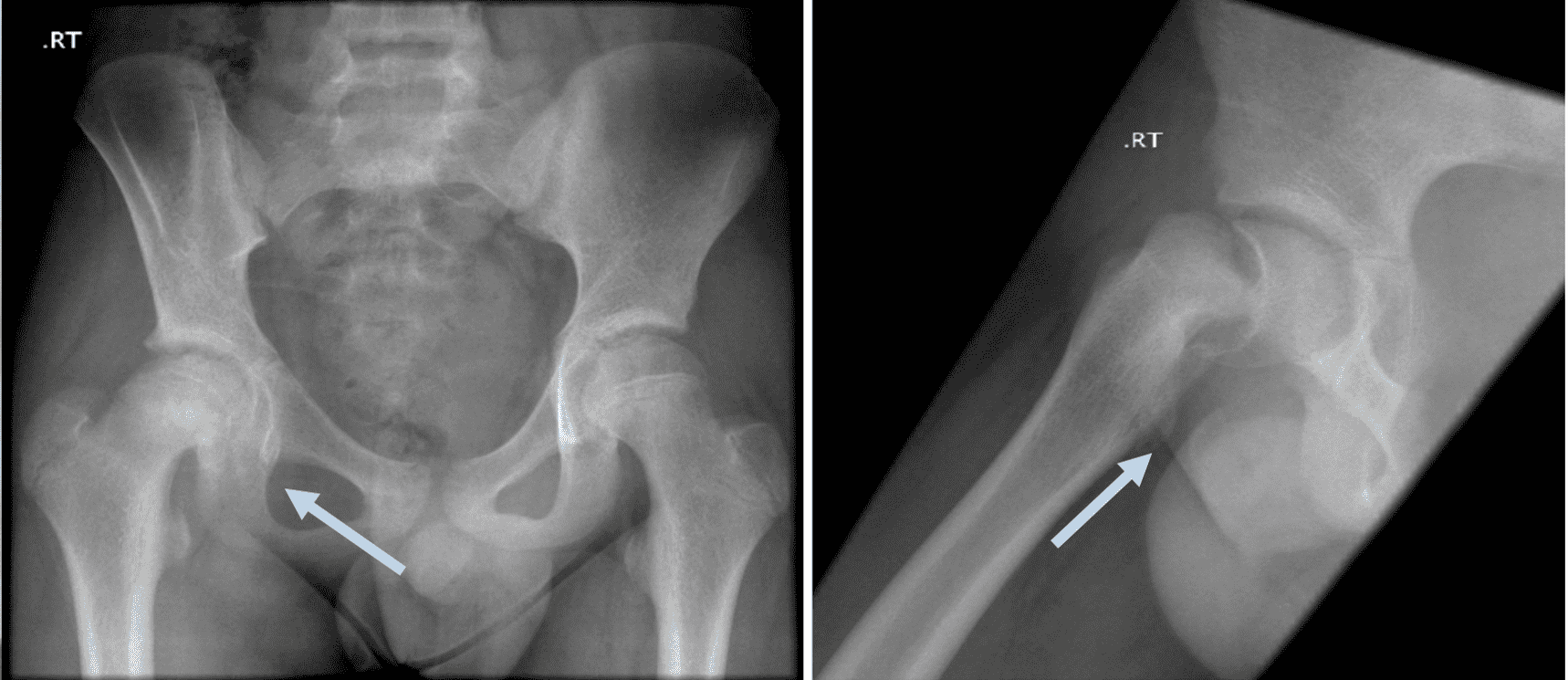 图1：正位和蛙状-侧位X光照片显示SCFE。