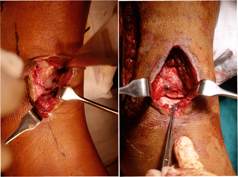 图27：术中照片，显示骨折和固定。