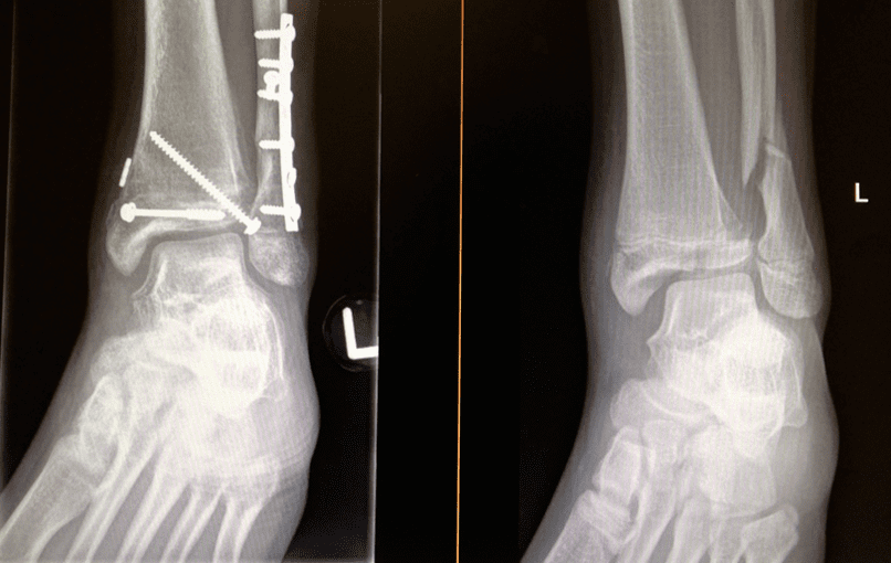 图28：另一例患者的三平面骨折合并踝关节骨折。