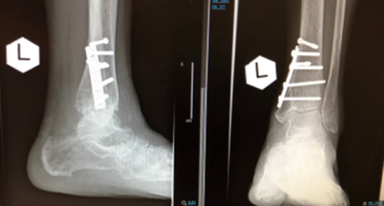 图6：x光片显示踝部骨折已愈合，环形固定架已移除。