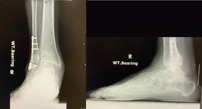 图9：X光检查显示移除环形固定器后的踝关节。