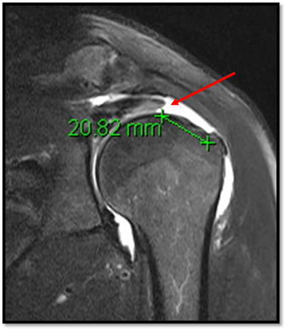 肩部MRI还可显示回缩性肩袖撕裂。