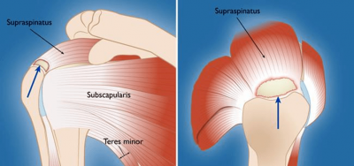 Picture-of-a-torn-rotator-cuff-tendon-Courtesy-of-orthoinfo.aaos_.org_