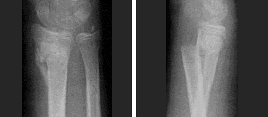 Wrist-fracture-5