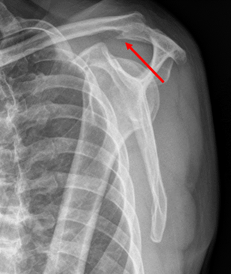 肩部X光检查显示骨刺可能压迫和损害肩袖肌腱。