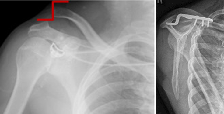 X-rays of a patient with right ACJ dislocation before and after open surgical reduction using a hook plate