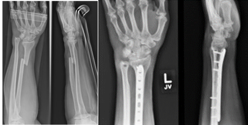 X光检查—前臂骨折