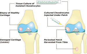 microfracture cartilage repair