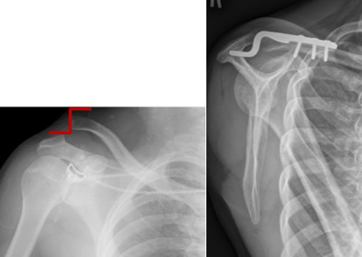 ACJ dislocation before and after open surgical reduction