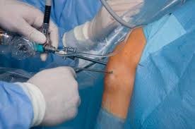 Arthroscopic meniscus surgery using 2 key-hole incisions