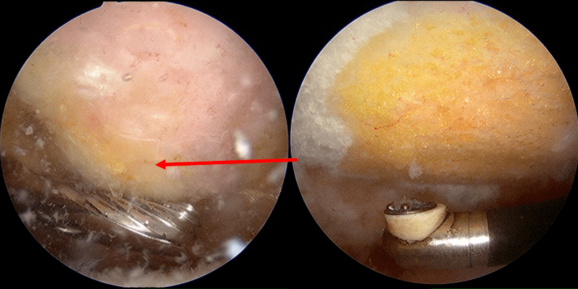 Arthroscopic view of a subacromial bone spur being shaven off with an arthroscopic burr.