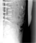 Anterior Spine Surgery