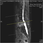 Inflammatory Spinal Conditions