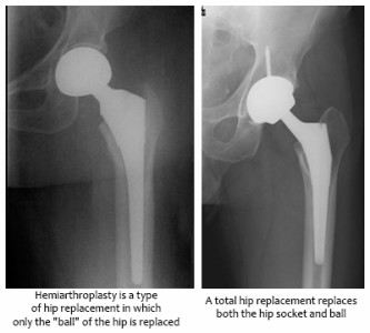 Displaced Hip Fracture Surgery Methods