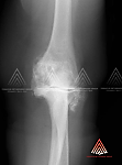 关节炎性肘伴骨刺形成、变性和关节间隙损耗 - 肘关节炎