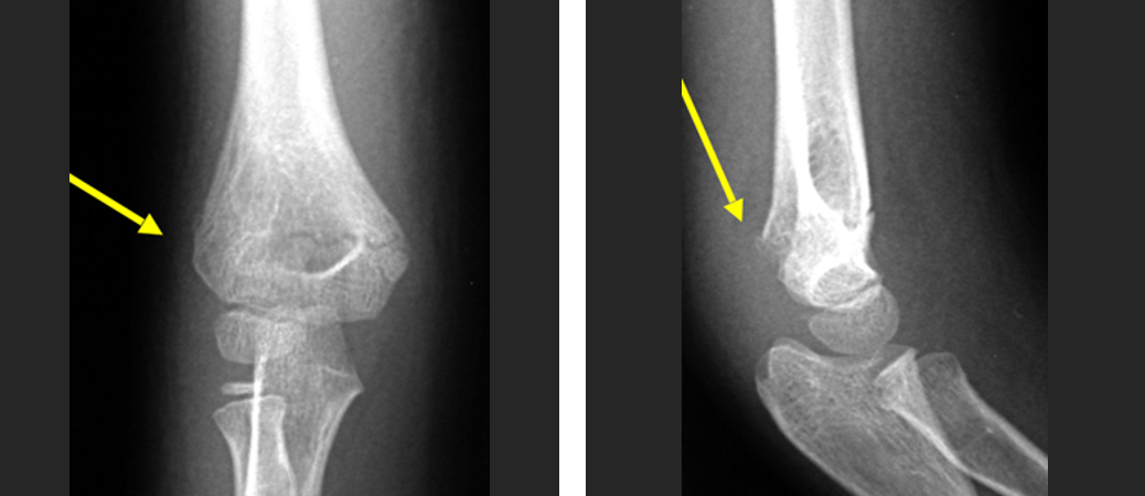 图14：1型损伤表现为无移位的骨折，可以用石膏保守治疗。