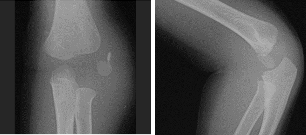 Elbow-Fracture-17