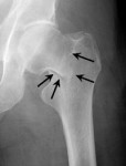 Femoral Neck Hip Fracture