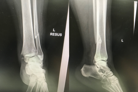 图1：踝关节损伤的X光检查。-踝关节骨折治疗