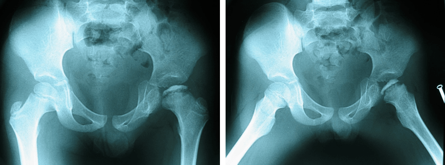 图1：正位(AP)X光照片（左图）及蛙式侧位片（右图）显示左侧髋关节病变。-儿童髋关节疼痛 