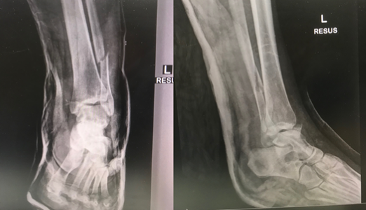 图2：X光检查显示踝关节暂时稳定在一个底板上。踝关节骨折治疗
